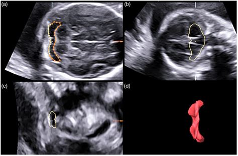arachnoid cyst vs mega cisterna magna|cisterna magna ultrasound fetal measurement.